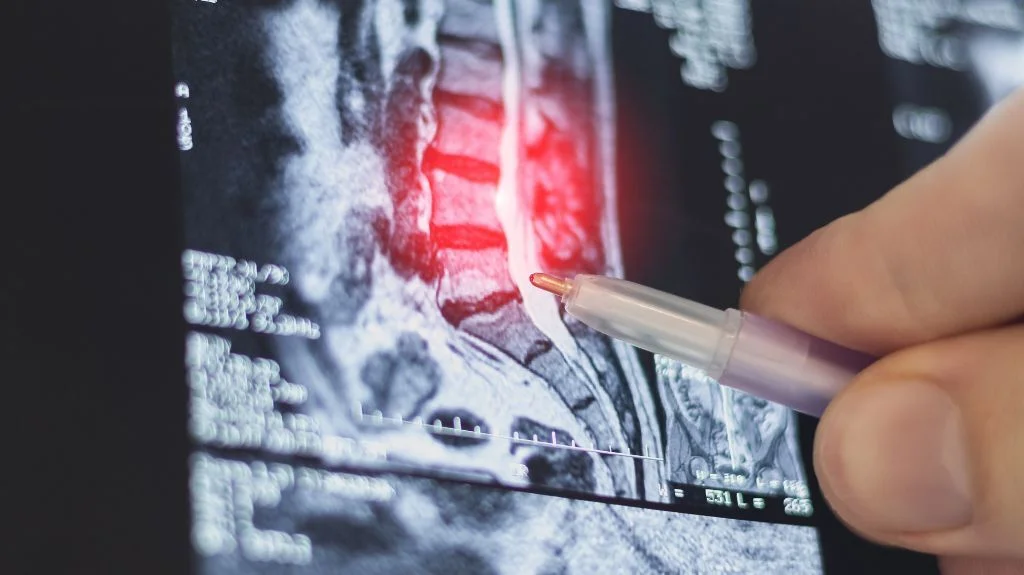 Close-up of a hand holding a pen pointing at a highlighted red area on a spinal MRI scan.